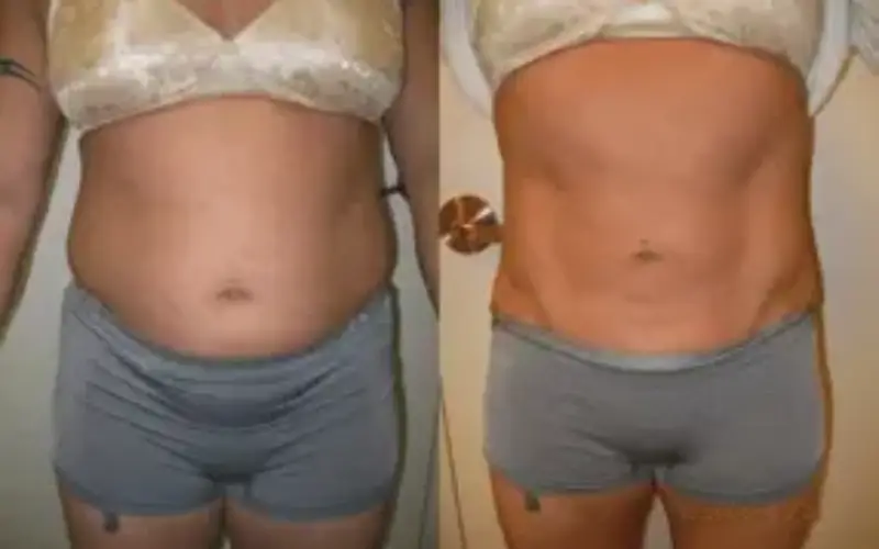 Cool Sculpting Cost Stomach: Pricing Out Stomach Slimming