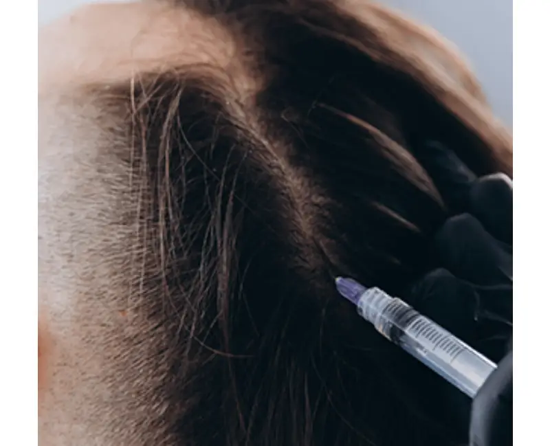 DHI Hair Transplant In Istanbul 