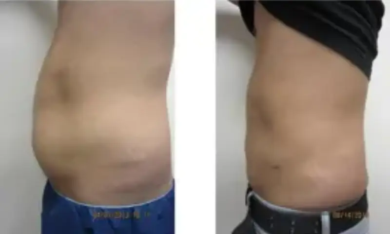 Cool Sculpting Cost Stomach: Pricing Out Stomach Slimming