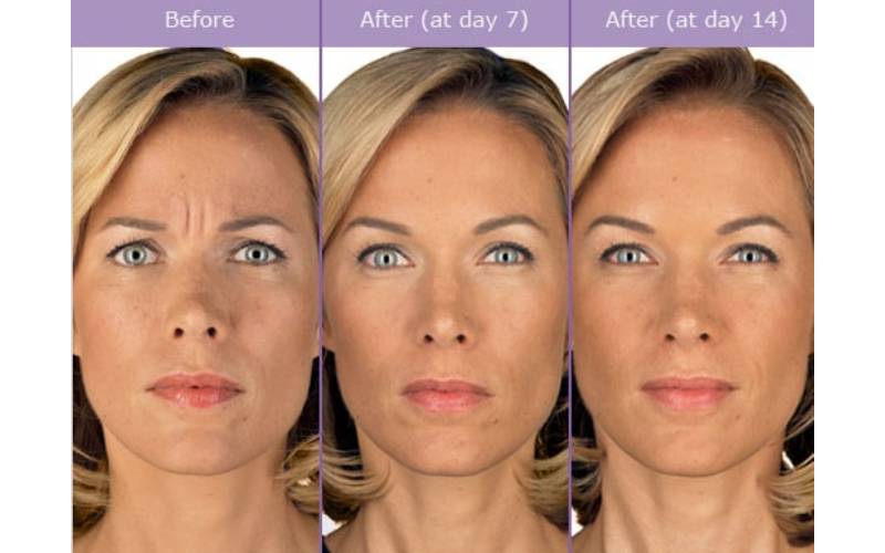 juvederm Washington DC
